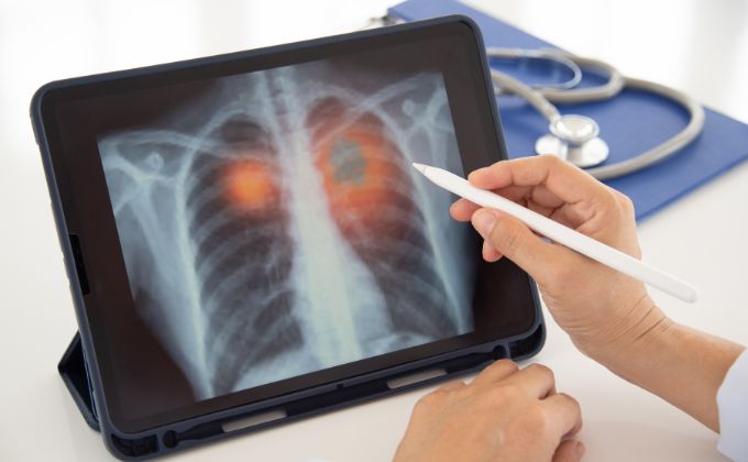 निमोनिया - Pneumonia Bacterial infection in Hindi 
