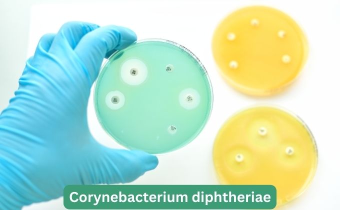 डिप्थीरिया - Diphtheria Caused by Bacterial infection in Hindi