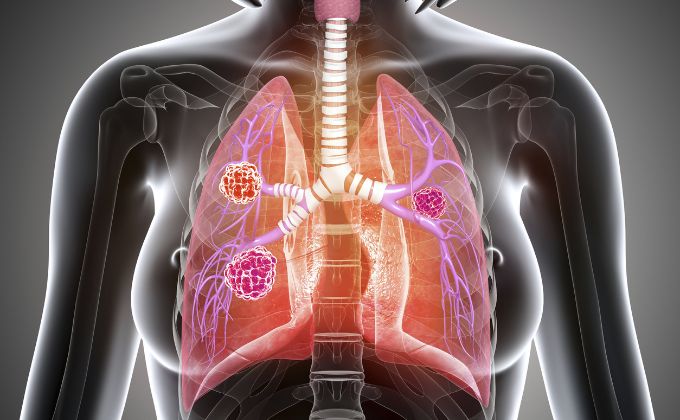 इंटरस्टीशियल लंग डिजीज - Interstitial lung disease in Hindi