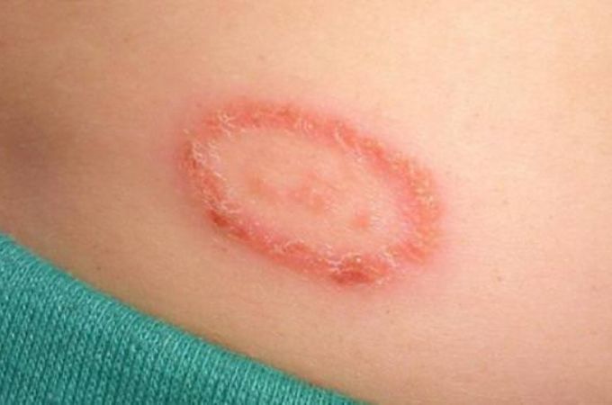 1. सतही फंगल संक्रमण - Superficial Fungal Infections In Hindi