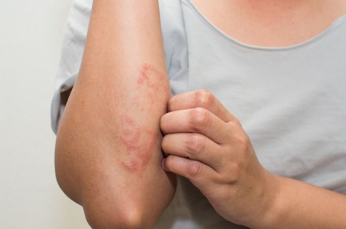 2. त्‍वचा के नीचे के फंगल रोग - Subcutaneous Fungal Diseases In Hindi