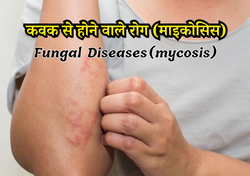 कवक से होने वाले रोग (माइकोसिस) - Fungal Diseases (mycosis) in Humans in Hindi
